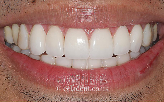 Porcelain Crowns