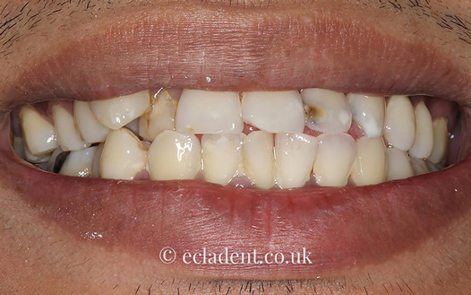 Porcelain Crowns