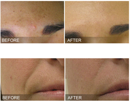 Hydrafacial in Mill Hill