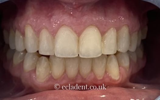 invisalign