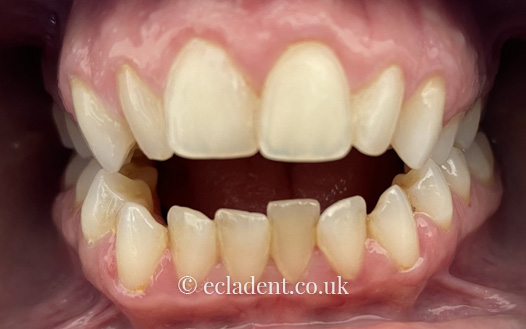 invisalign
