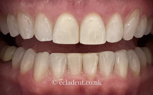 Invisalign
