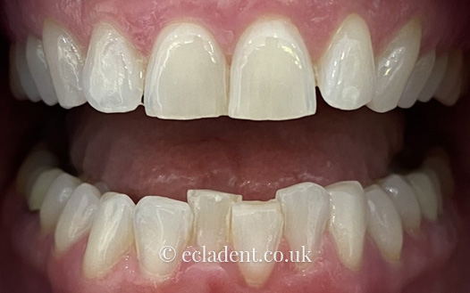 Invisalign