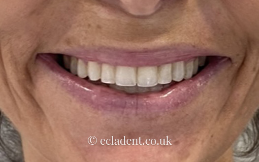 invisalign