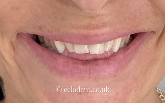 invisalign