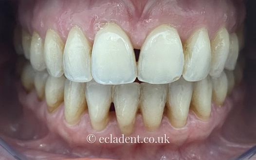 invisalign