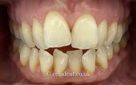 invisalign