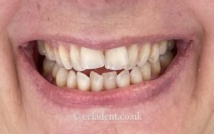 invisalign