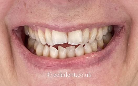 invisalign