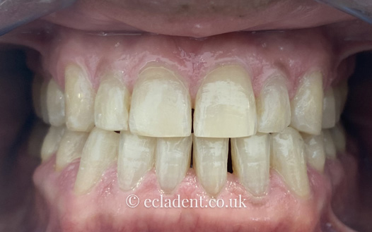 invisalign