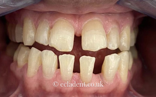 invisalign