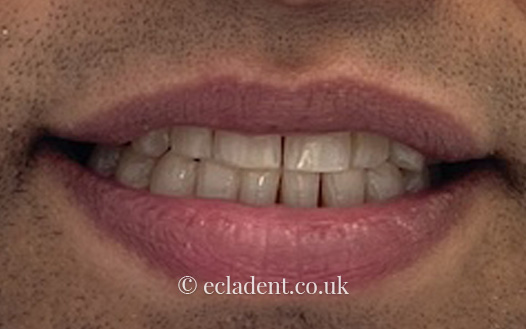 invisalign