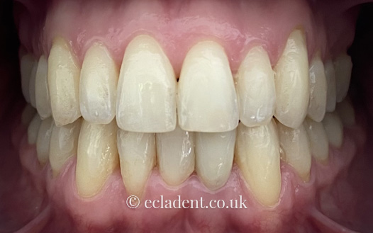 invisalign
