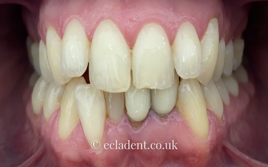 invisalign