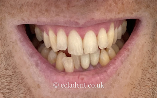 invisalign