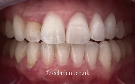 Invisalign