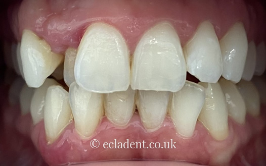 Invisalign